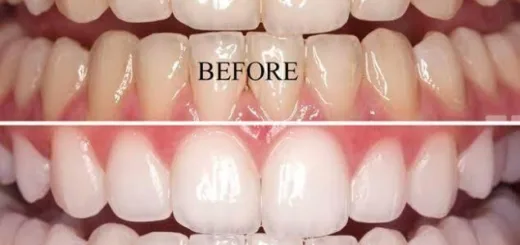 teeth whitening in Nigeria